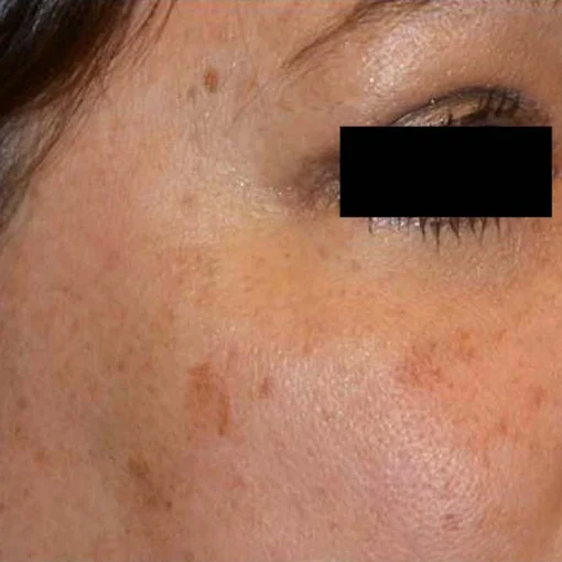 Picosure before 6