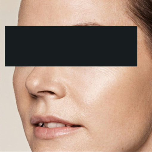 Skin Booster after 2
