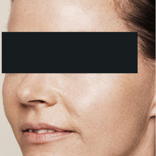 Skin Booster before 2