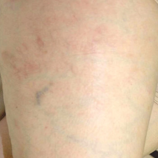 Spider Vein Treatment after 4