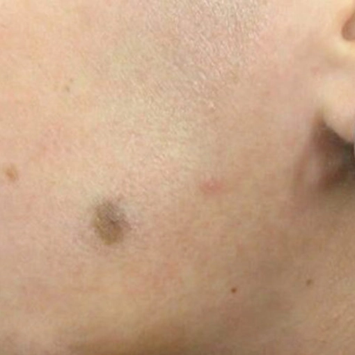 Spider Vein Treatment after 5