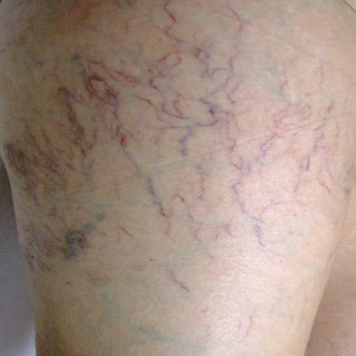 Spider Vein Treatment before 4