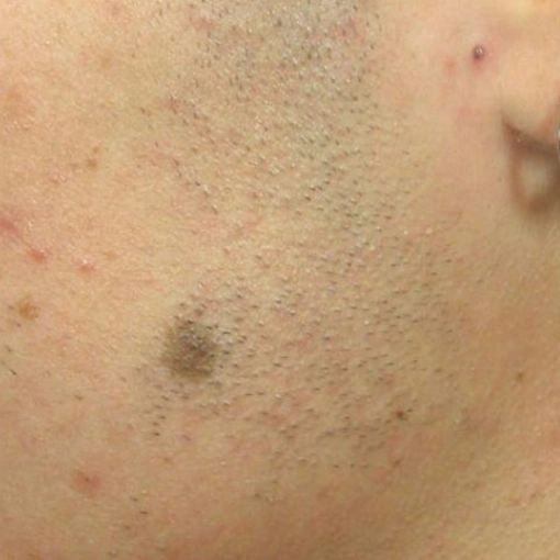Spider Vein Treatment before 5