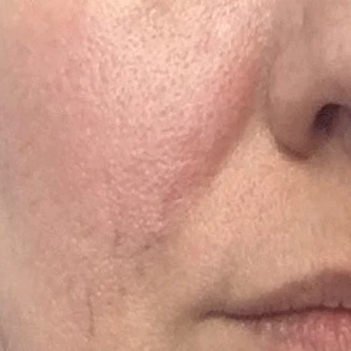 Vascular Removal after 4