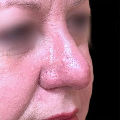 Vascular Removal after 5