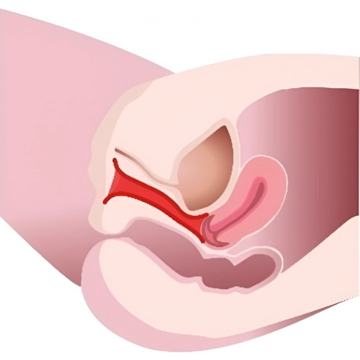 diVa Vaginal Rejuvenation after 1