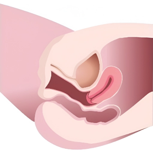 diVa Vaginal Rejuvenation before 1