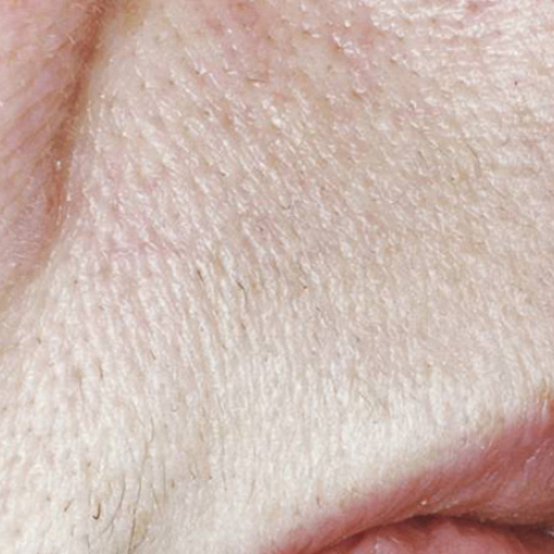 laser hair removal after 4