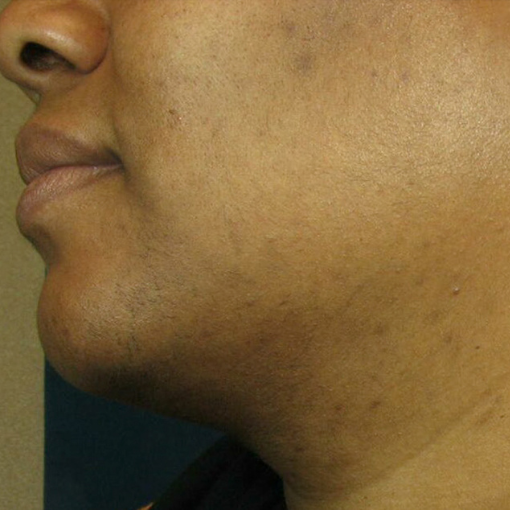 laser hair removal after 5