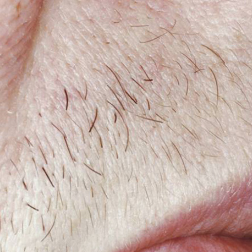 laser hair removal before 4