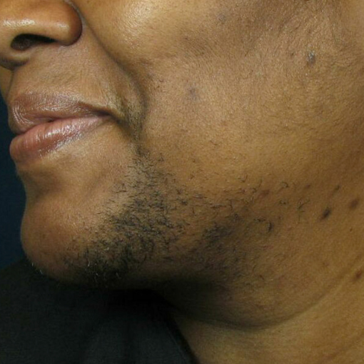laser hair removal before 5