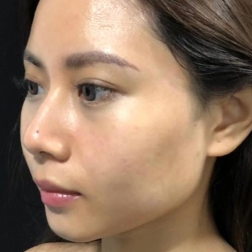 glass facial after 2