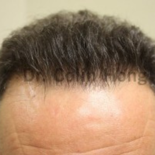 Hair Transplant after 1