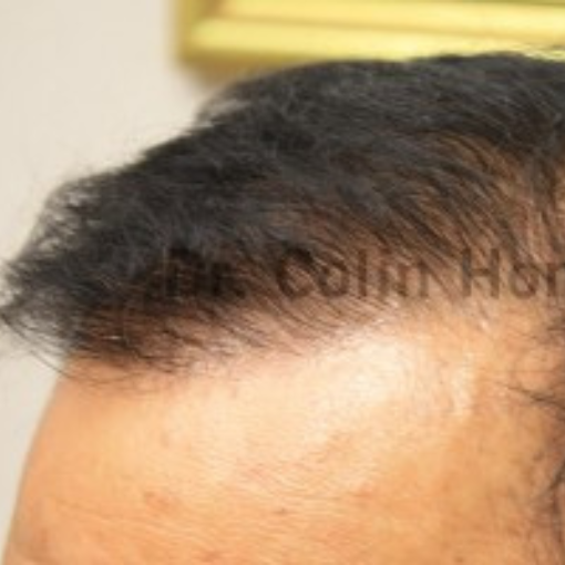 Hair Transplant after 2