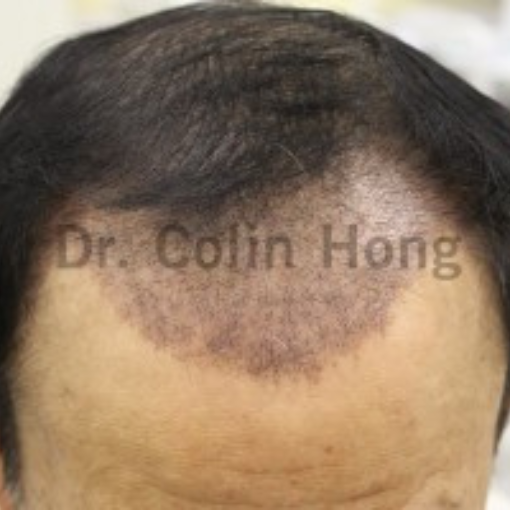 Hair Transplant after 3