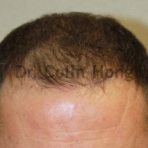 Hair Transplant before 1