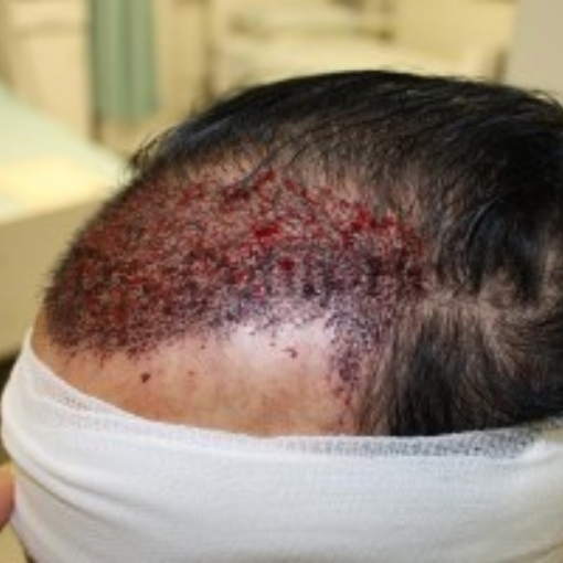 Hair Transplant before 2