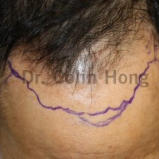 Hair Transplant before 3