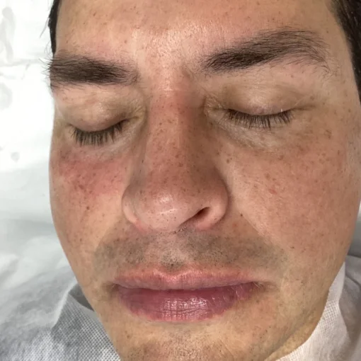 hydrafacial before after after 3