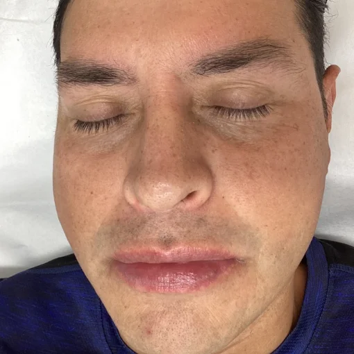 hydrafacial before after before 3