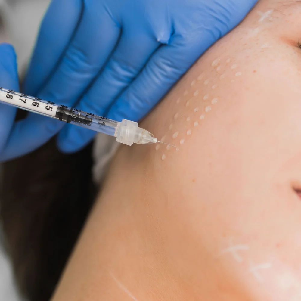 mesotherapy in signature cosmetic clinic