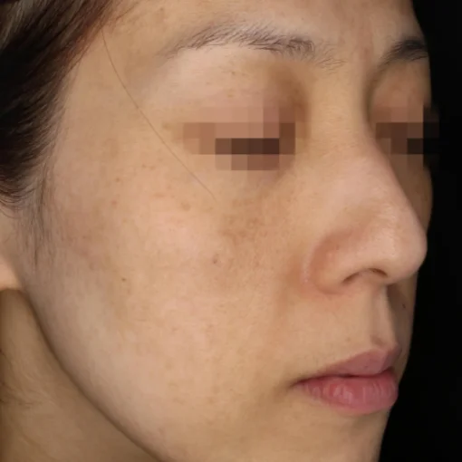 picosure before after after 4
