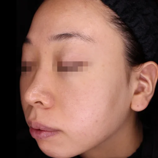 picosure before after after 5