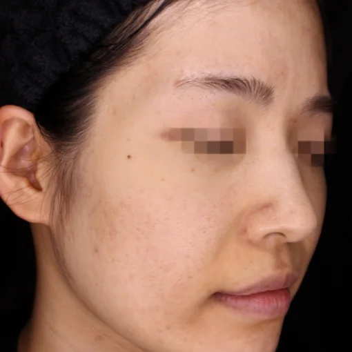 picosure before after after 6