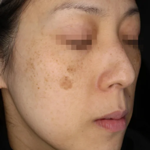 picosure before after before 4