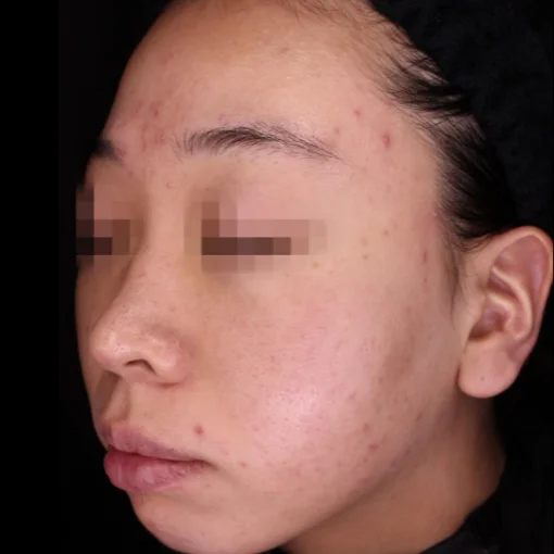 picosure before after before 5