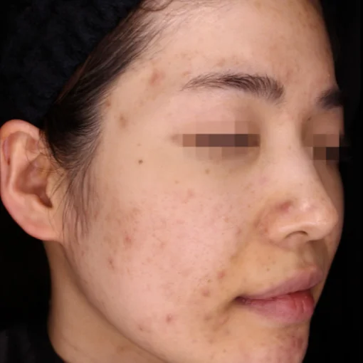 picosure before after before 6
