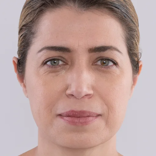 Sculptra face lift after 2