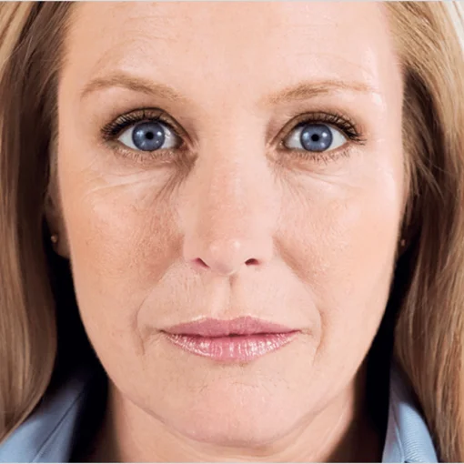 Sculptra face lift after 3
