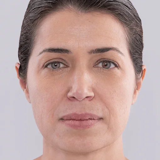 Sculptra face lift before 2