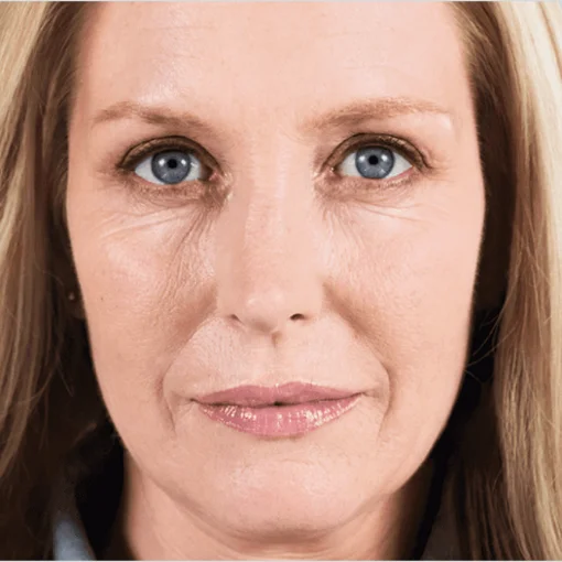 Sculptra face lift before 3