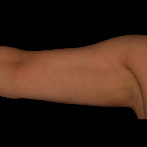 signature cosmetic clinic coolsculpting before after 1