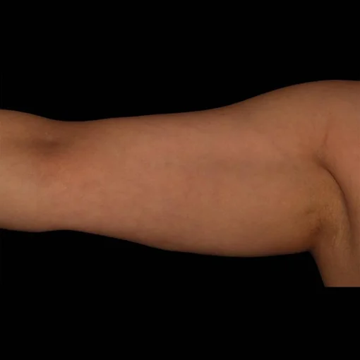 signature cosmetic clinic coolsculpting before after 2