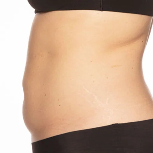 signature cosmetic clinic coolsculpting before after 3