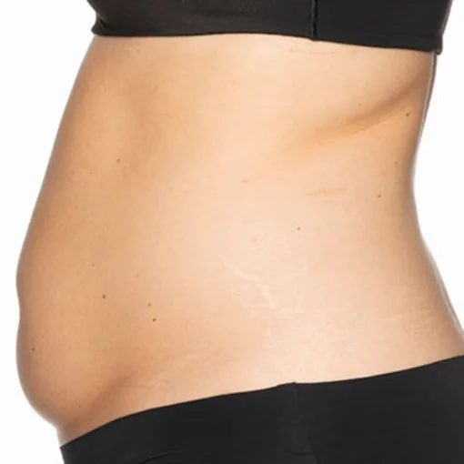 signature cosmetic clinic coolsculpting before after 4