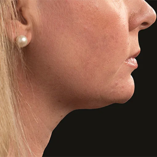 signature cosmetic clinic coolsculpting before after 5