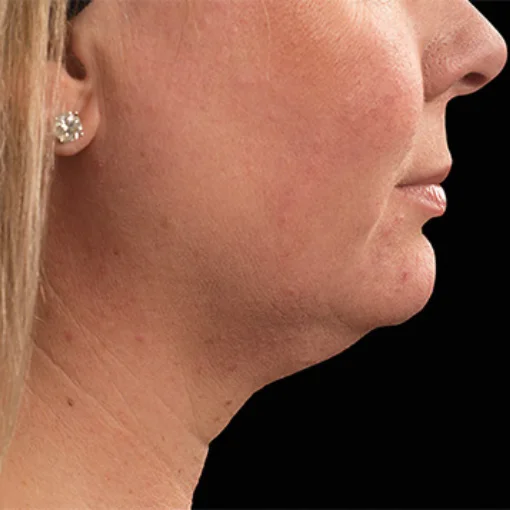signature cosmetic clinic coolsculpting before after 6
