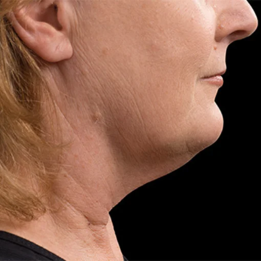 signature cosmetic clinic coolsculpting before after 7