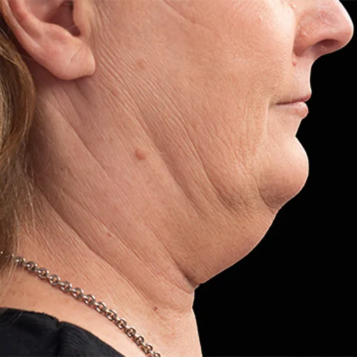 signature cosmetic clinic coolsculpting before after 8