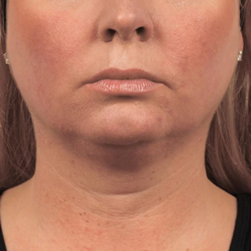 signature cosmetic clinic coolsculpting before after 9
