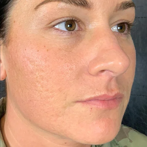 signature cosmetic clinic microneedling before after 1