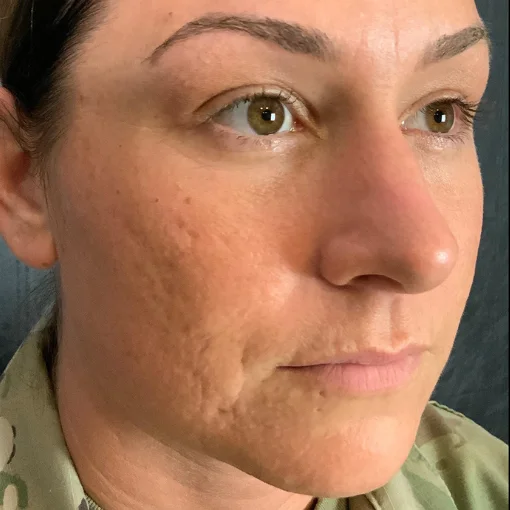 signature cosmetic clinic microneedling before after 2