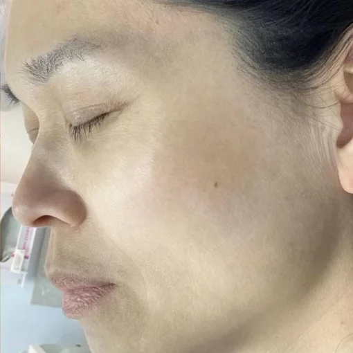 signature cosmetic clinic picosure after 7