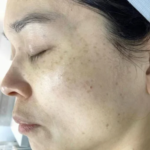 signature cosmetic clinic picosure before 7