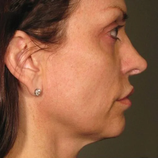 signature cosmetic clinic ultherapy after 1