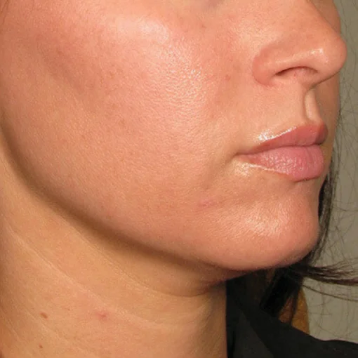 signature cosmetic clinic ultherapy after 3